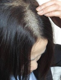 斑秃护理